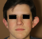  Bandingkan Sebelum & Sesudah Foto Otoplasty