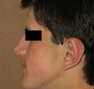  Bandingkan Sebelum & Sesudah Foto Otoplasty