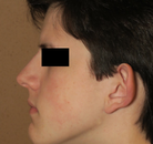  Bandingkan Sebelum & Sesudah Foto Otoplasty