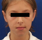  Bandingkan Sebelum & Sesudah Foto Otoplasty