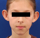  Bandingkan Sebelum & Sesudah Foto Otoplasty