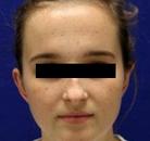  Bandingkan Sebelum & Sesudah Foto Otoplasty