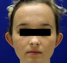  Bandingkan Sebelum & Sesudah Foto Otoplasty