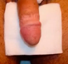  Bandingkan Sebelum & Sesudah Foto Augmentasi Penis