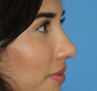  Bandingkan Sebelum & Sesudah Foto Operasi Hidung