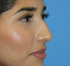  Bandingkan Sebelum & Sesudah Foto Operasi Hidung