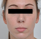  Bandingkan Sebelum & Sesudah Foto Operasi Hidung