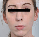  Bandingkan Sebelum & Sesudah Foto Operasi Hidung