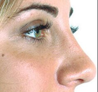  Bandingkan Sebelum & Sesudah Foto Operasi Hidung