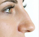  Bandingkan Sebelum & Sesudah Foto Operasi Hidung