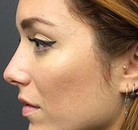  Bandingkan Sebelum & Sesudah Foto Operasi Hidung