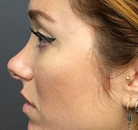  Bandingkan Sebelum & Sesudah Foto Operasi Hidung