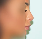  Bandingkan Sebelum & Sesudah Foto Operasi Hidung