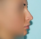  Bandingkan Sebelum & Sesudah Foto Operasi Hidung