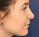  Bandingkan Sebelum & Sesudah Foto Operasi Hidung