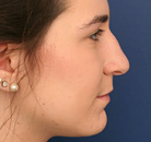  Bandingkan Sebelum & Sesudah Foto Operasi Hidung