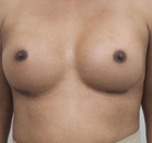  Bandingkan Sebelum & Sesudah Foto Augmentasi Payudara Pria