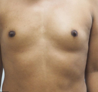  Bandingkan Sebelum & Sesudah Foto Augmentasi Payudara Pria