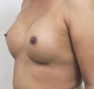  Bandingkan Sebelum & Sesudah Foto Augmentasi Payudara Pria