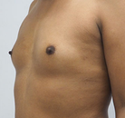  Bandingkan Sebelum & Sesudah Foto Augmentasi Payudara Pria