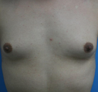  Bandingkan Sebelum & Sesudah Foto Augmentasi Payudara Pria