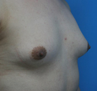  Bandingkan Sebelum & Sesudah Foto Augmentasi Payudara Pria