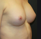  Bandingkan Sebelum & Sesudah Foto Augmentasi Payudara Pria