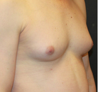  Bandingkan Sebelum & Sesudah Foto Augmentasi Payudara Pria