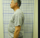  Bandingkan Sebelum & Sesudah Foto Pengobatan Chiropractic