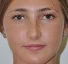  Bandingkan Sebelum & Sesudah Foto Rinoplasti