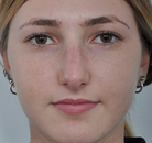  Bandingkan Sebelum & Sesudah Foto Rinoplasti