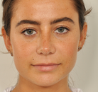  Bandingkan Sebelum & Sesudah Foto Rinoplasti