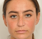  Bandingkan Sebelum & Sesudah Foto Rinoplasti