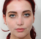  Bandingkan Sebelum & Sesudah Foto Rinoplasti