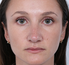  Bandingkan Sebelum & Sesudah Foto Rinoplasti