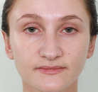  Bandingkan Sebelum & Sesudah Foto Rinoplasti