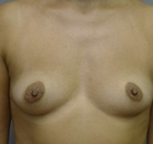  Bandingkan Sebelum & Sesudah Foto Augmentasi Payudara