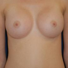 Compare Before & After Photos of _procedure_photos.phpBreast Augmentation