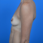 Compare Before & After Photos of _procedure_photos.phpBreast Augmentation