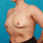 Compare Before & After Photos of _procedure_photos.phpBreast Augmentation