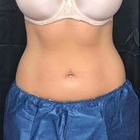Compare Before & After Photos of _procedure_photos.phpCoolSculpting