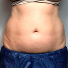 Compare Before & After Photos of _procedure_photos.phpCoolSculpting