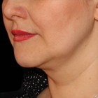 Compare Before & After Photos of _procedure_photos.phpCoolSculpting