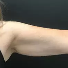 Compare Before & After Photos of _procedure_photos.phpCoolSculpting