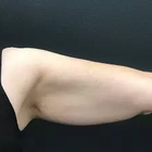 Compare Before & After Photos of _procedure_photos.phpCoolSculpting