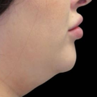 Compare Before & After Photos of _procedure_photos.phpCoolSculpting