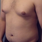 Compare Before & After Photos of _procedure_photos.phpCoolSculpting