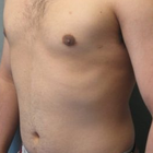 Compare Before & After Photos of _procedure_photos.phpCoolSculpting