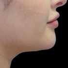 Compare Before & After Photos of _procedure_photos.phpCoolSculpting