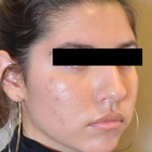 Compare Before & After Photos of _procedure_photos.phpRhinoplasty